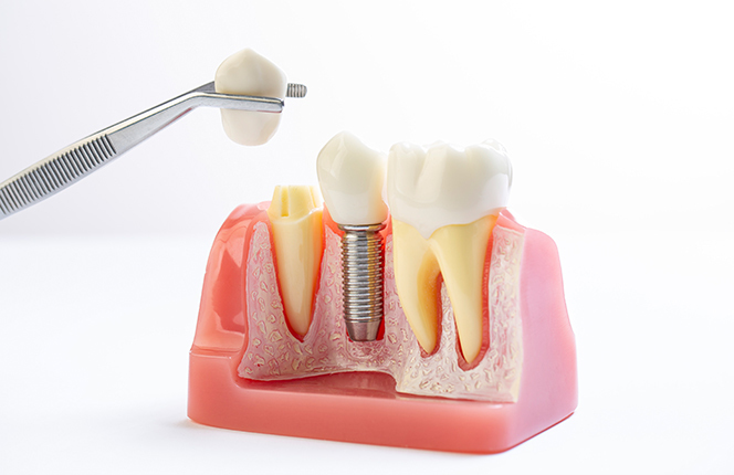 DENTIST|원데이 임플란트